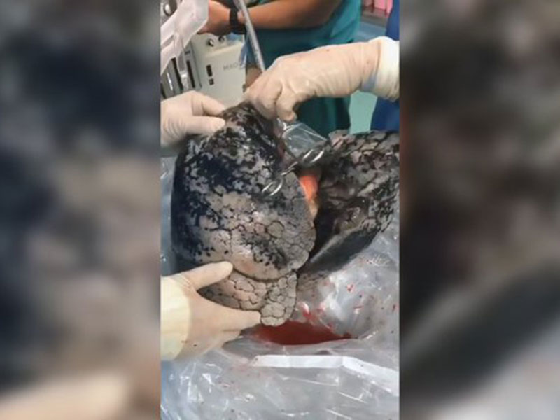 فيديو مروع لرئتي رجل دخن السجائر لـ 30 عامًا